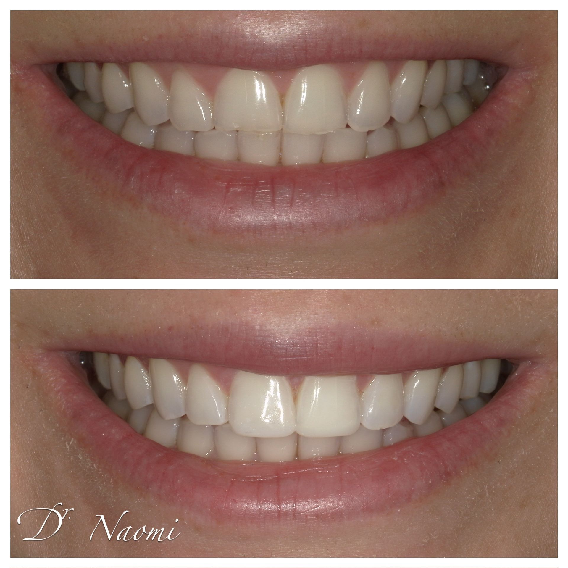 Before-and-after close-up of a smile, showing whiter teeth in the lower image.