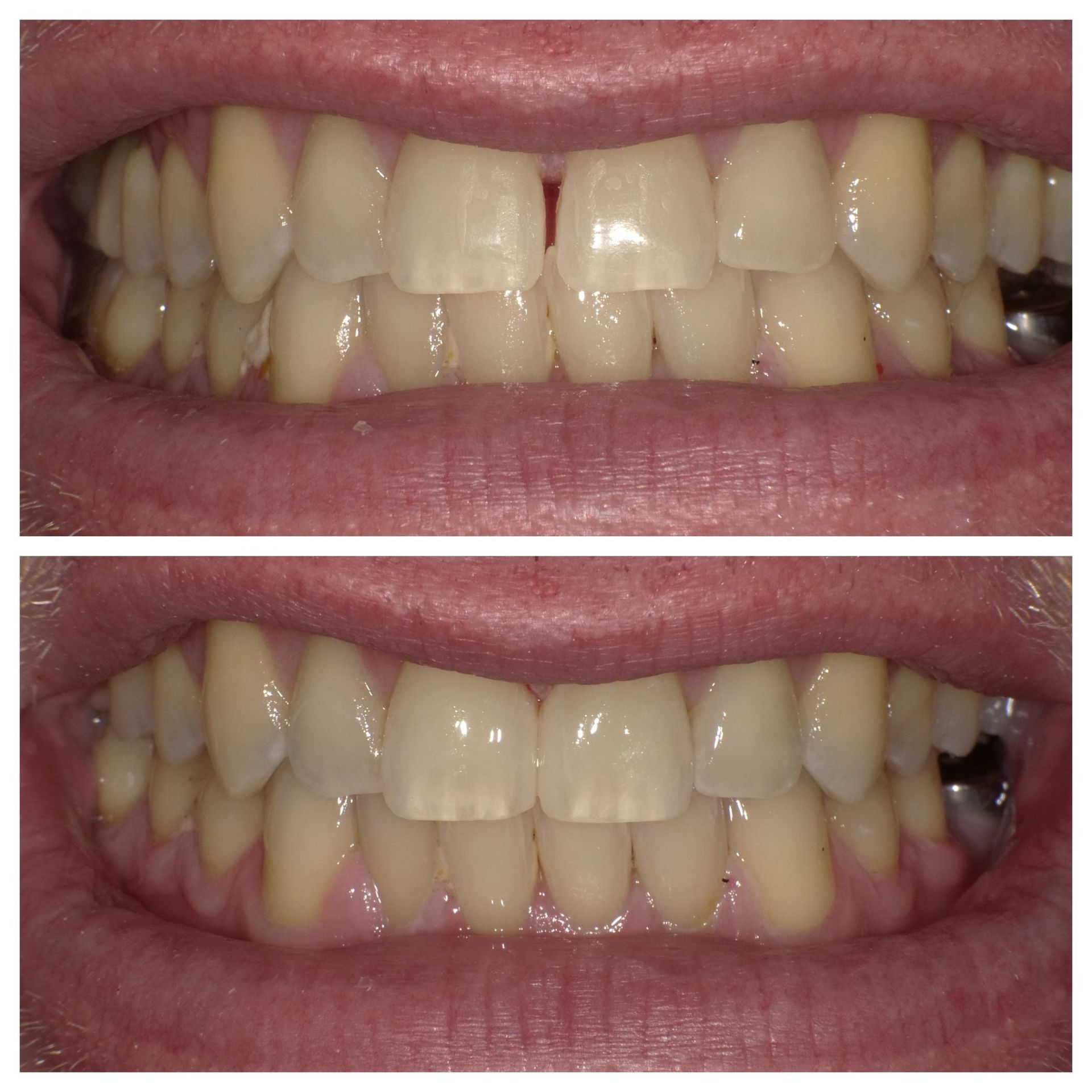 Close-up of a mouth showing teeth before and after whitening, with the top row brighter in the lower image