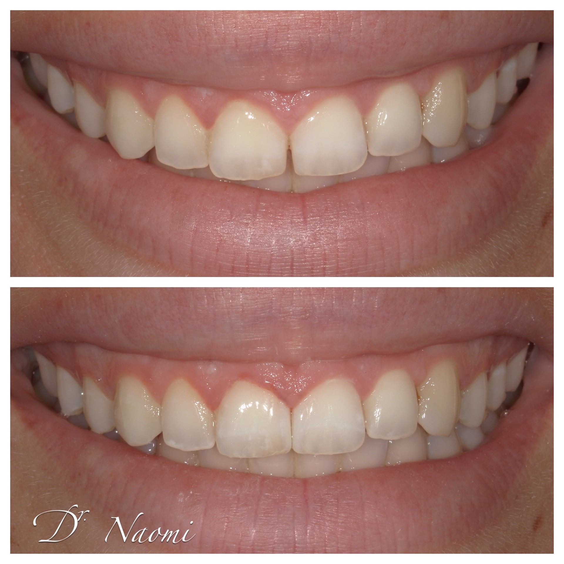 Close-up of two smiles, top with yellowed teeth and bottom with whiter, brighter teeth.