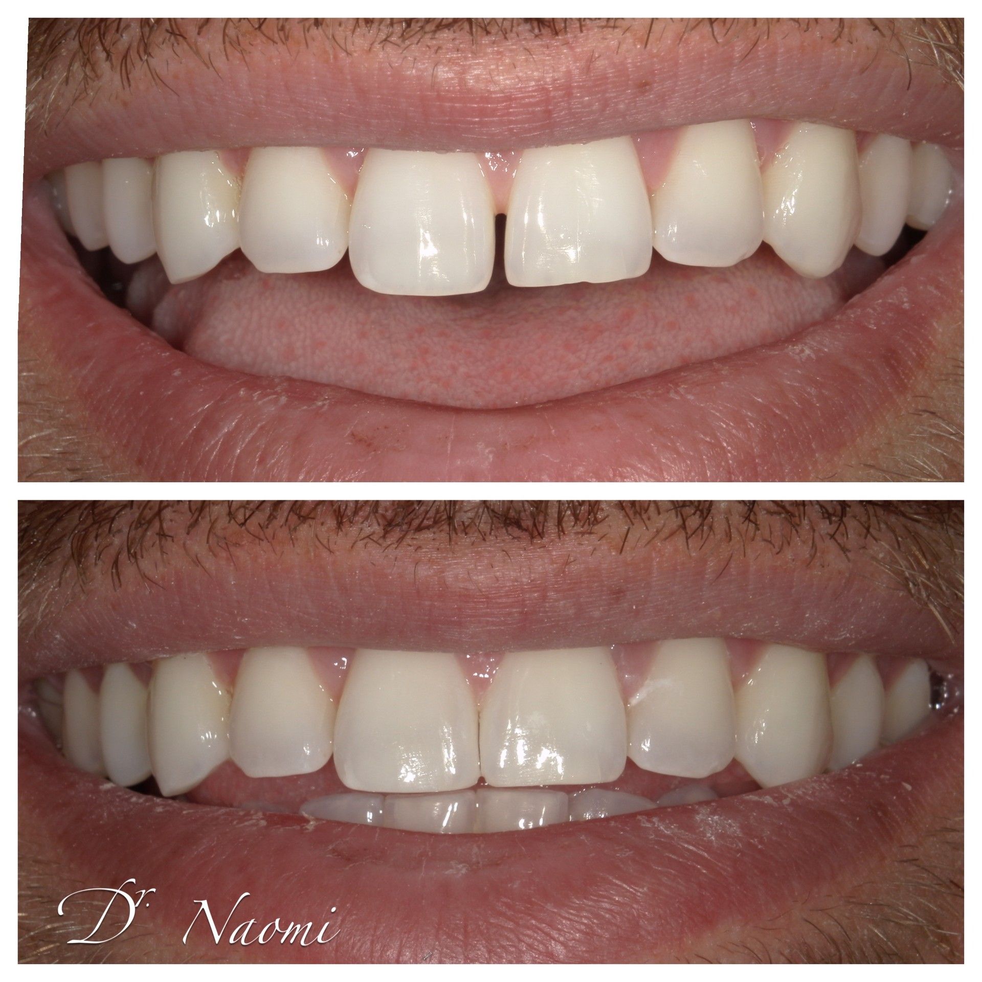 Before-and-after close-up of front teeth, showing improved alignment and whiter appearance