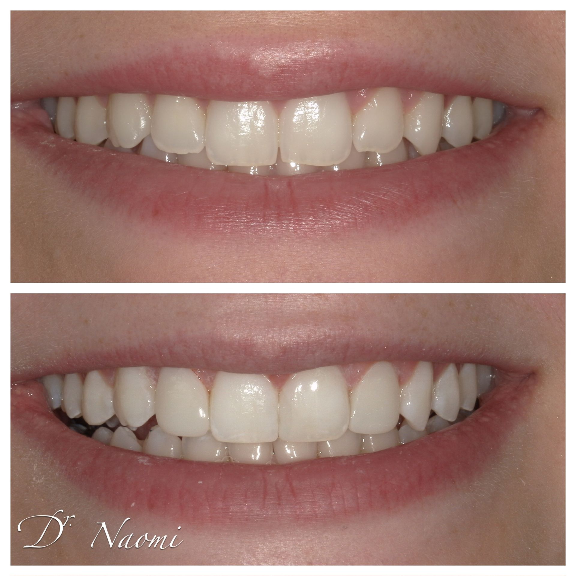 Split before-and-after close-up of a smiling mouth with brighter, whiter teeth