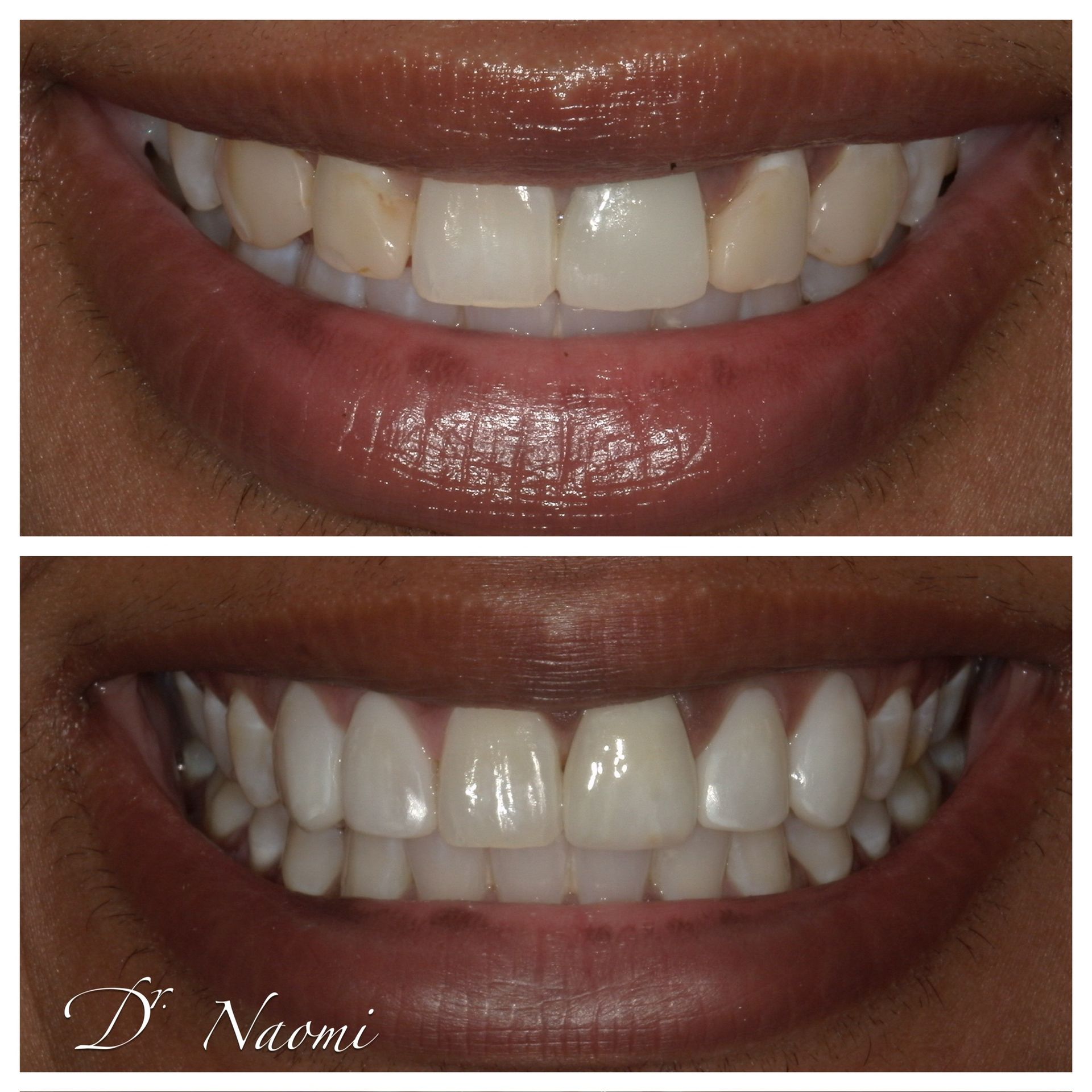 Before-and-after close-up of a smiling mouth showing brighter, whiter teeth.