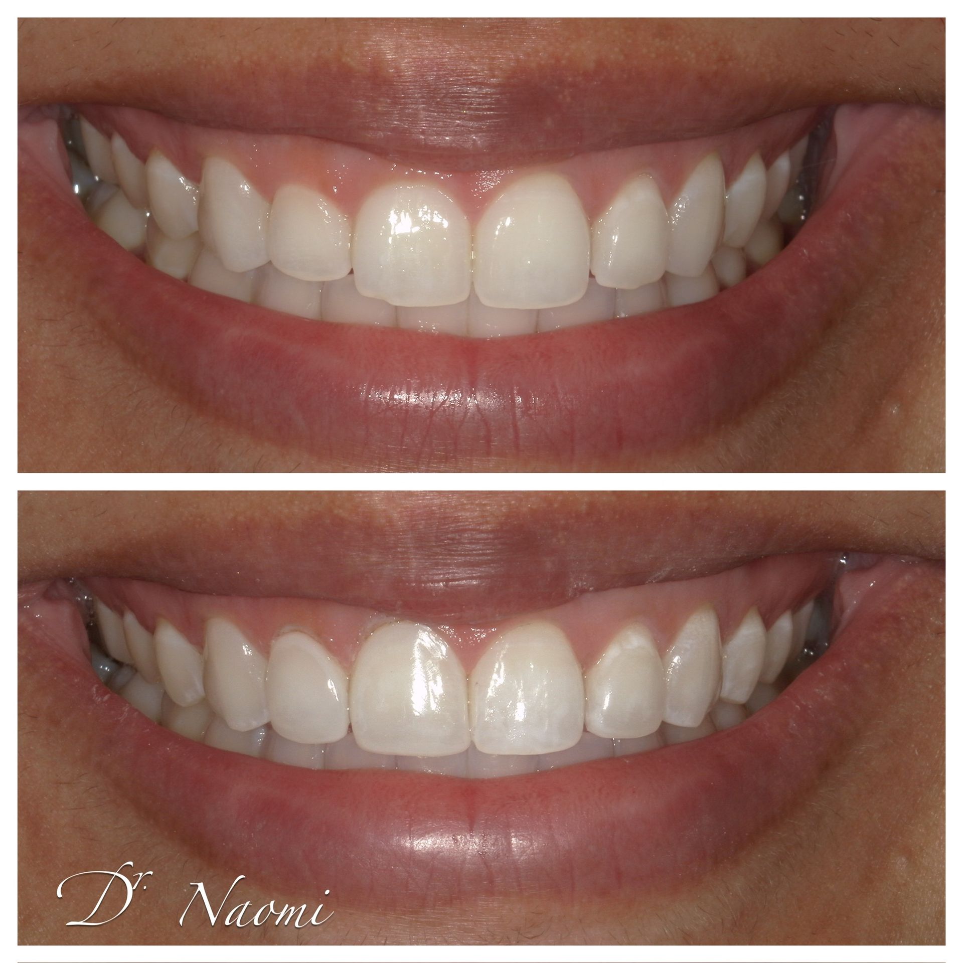 Close-up of a smiling mouth showing white teeth, with before-and-after comparison of whitening.