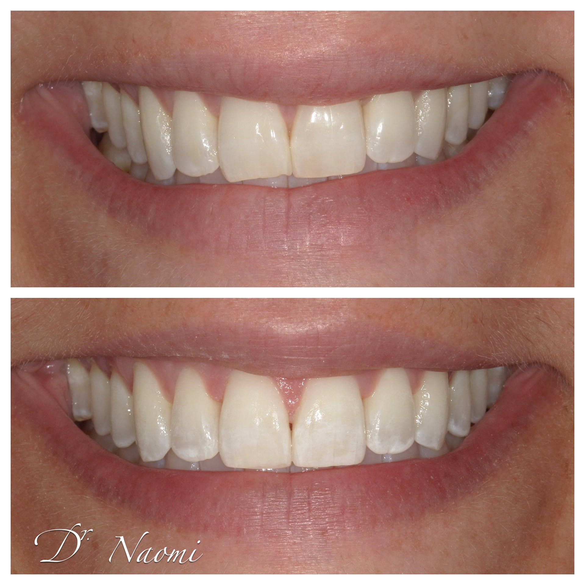 Close-up of a smiling mouth showing teeth before and after whitening treatment.