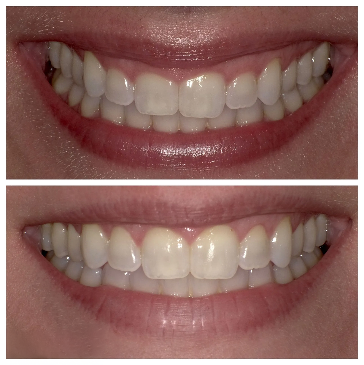 Two smiling mouths, showing teeth before and after whitening treatment