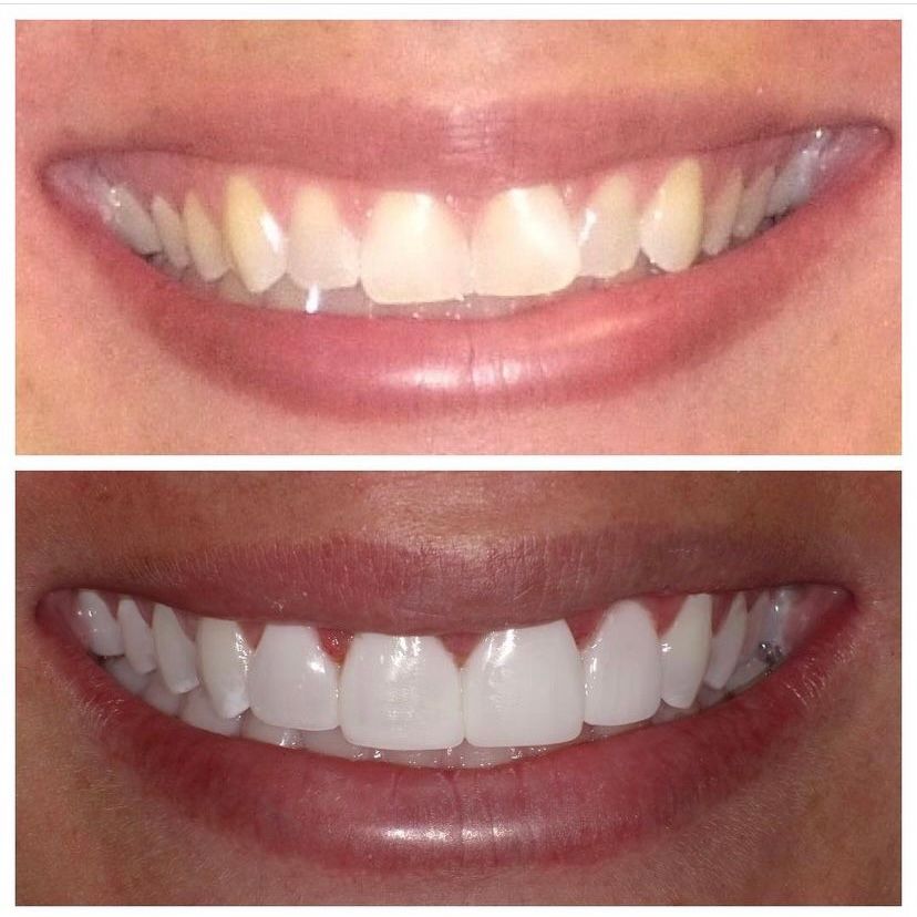 Smile comparison showing yellowed teeth above and brighter whitened teeth below