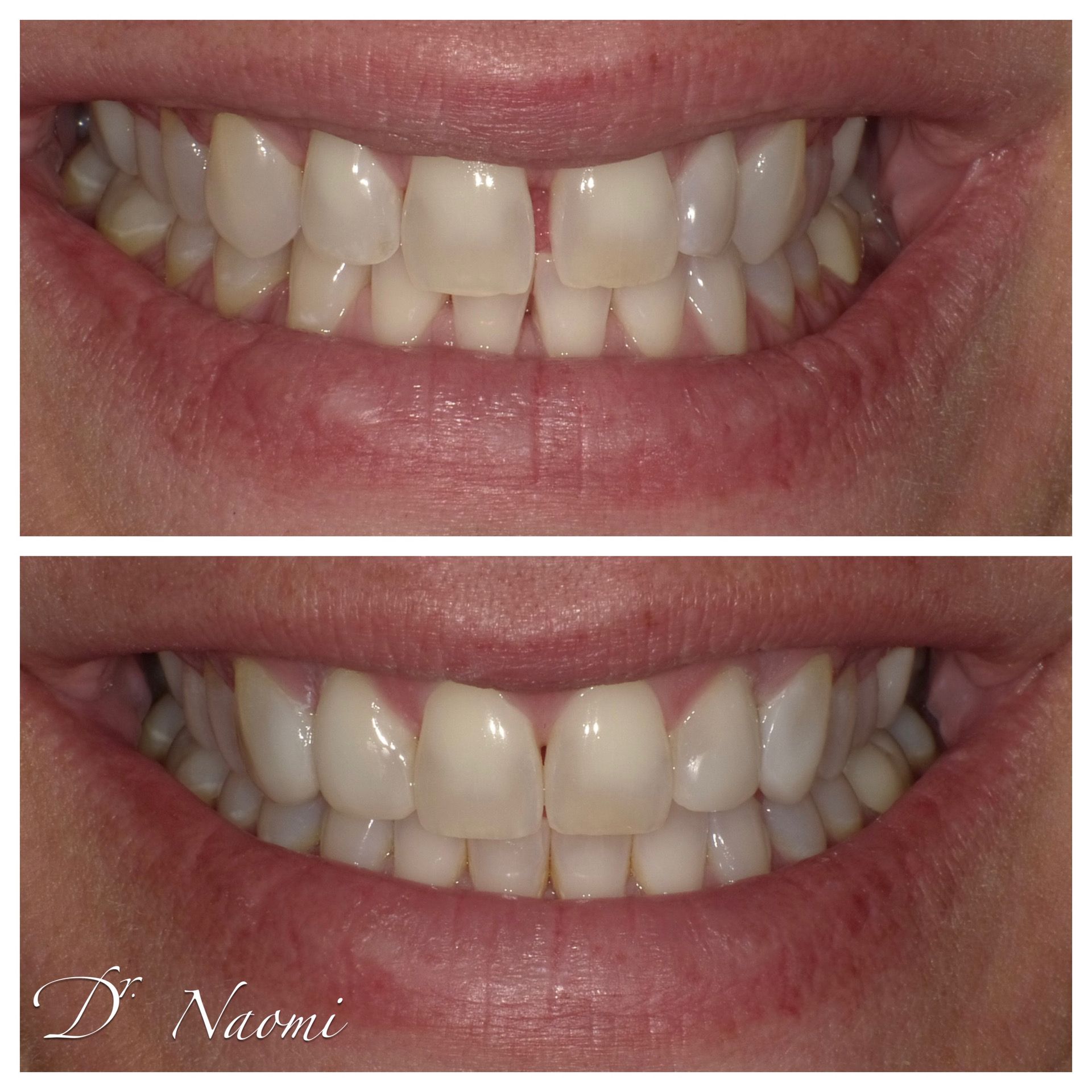 Close-up of a smiling mouth showing teeth, before-and-after comparison in two stacked photos.