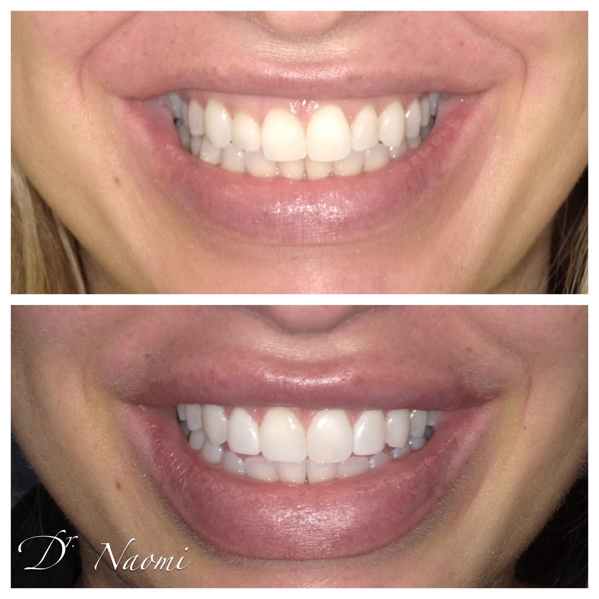 Split before-and-after close-up of a smiling mouth showing whiter teeth after treatment
