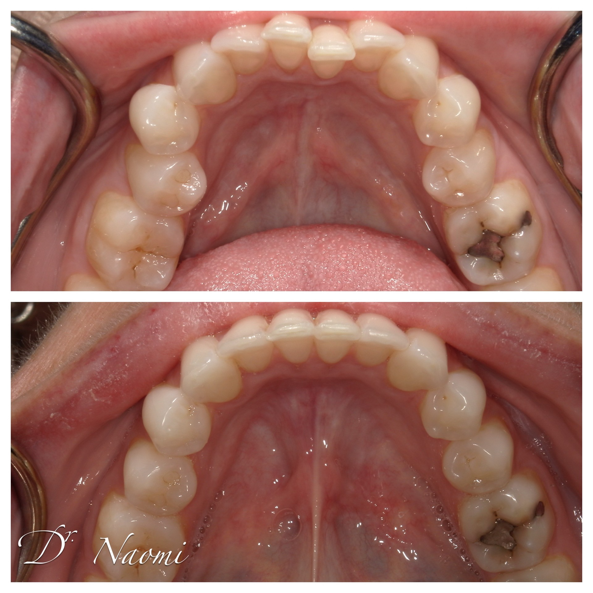 Two close-up photos of the upper teeth and palate, showing dental arches and molars.