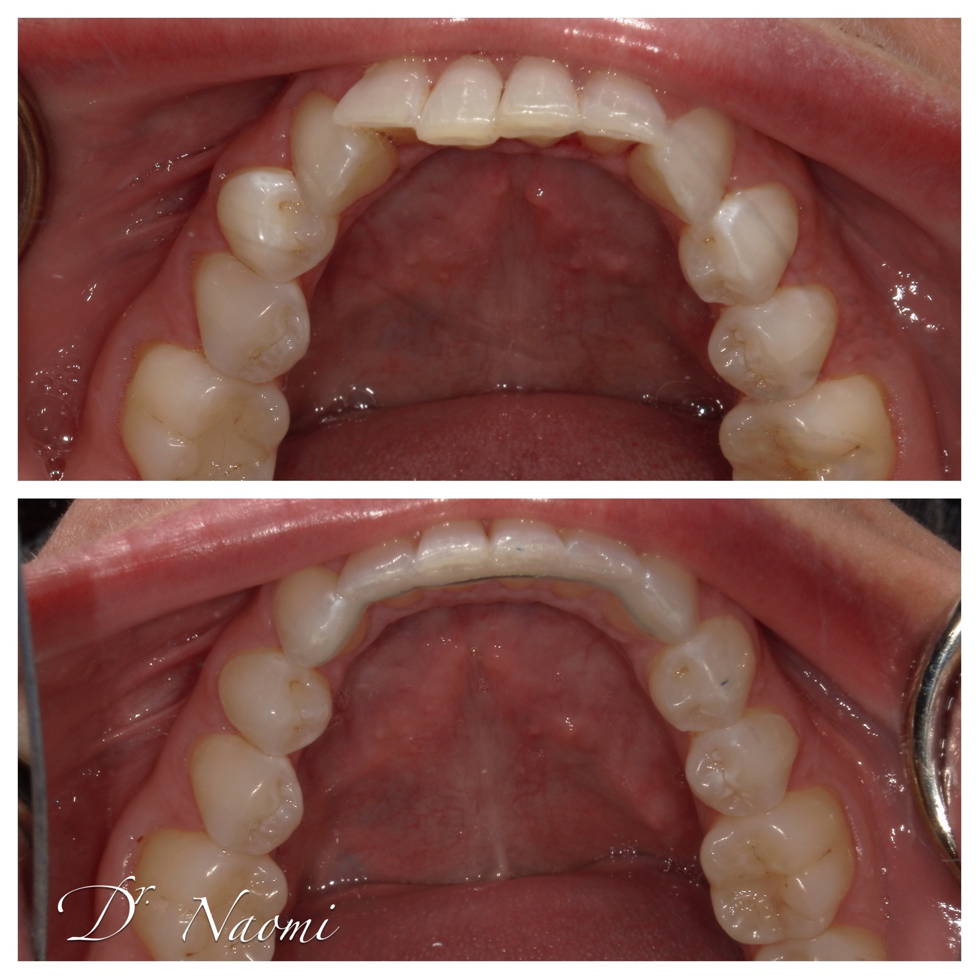 Two intraoral photos showing the upper teeth and palate from above.