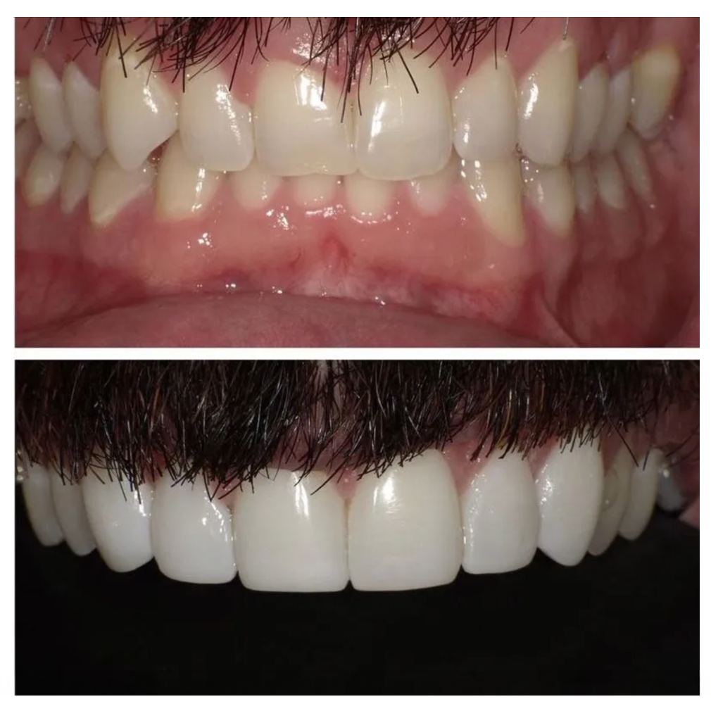 Before-and-after close-up of teeth, with whitening and straighter alignment in the lower image.