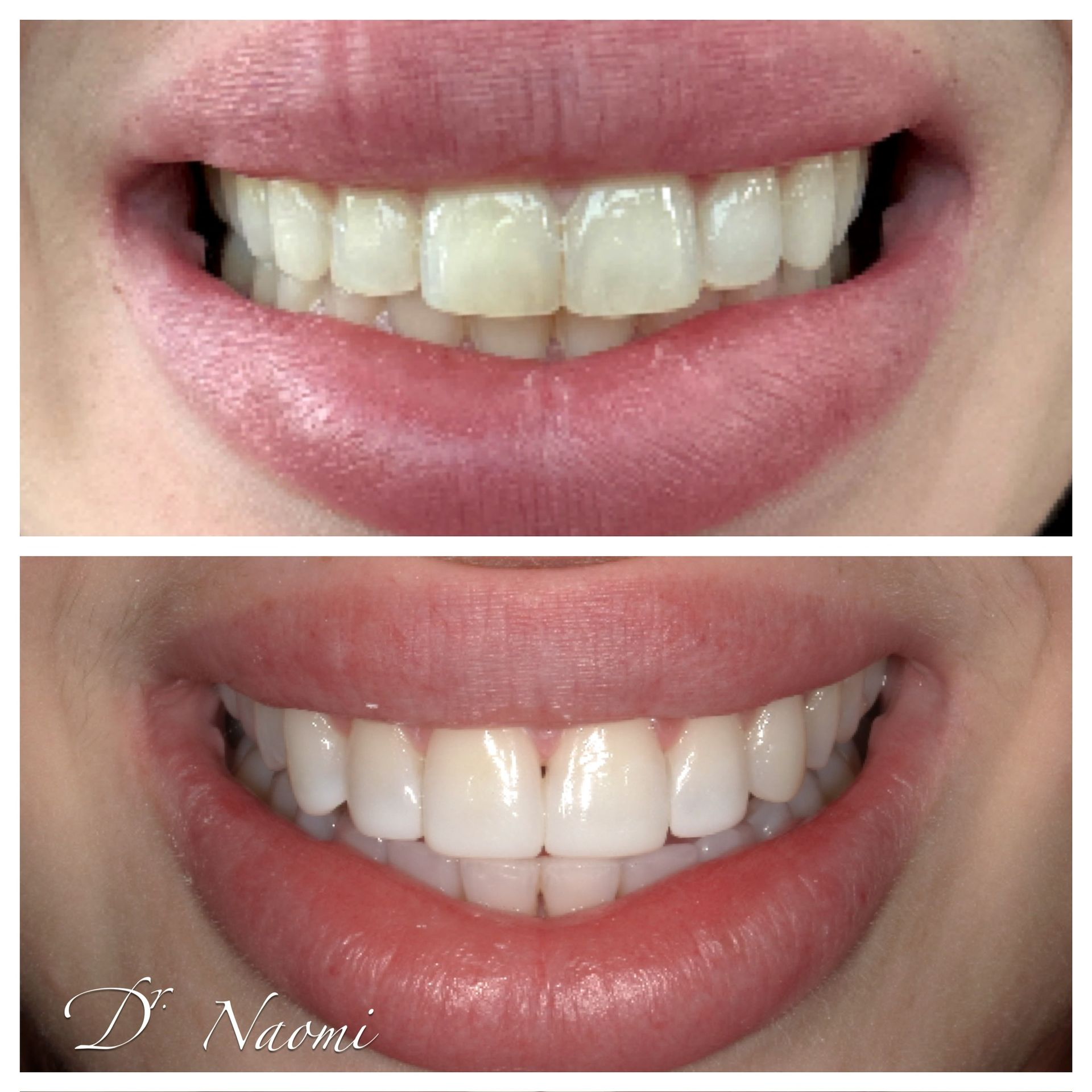 Before-and-after close-up of a smiling mouth with whiter teeth and pink lips