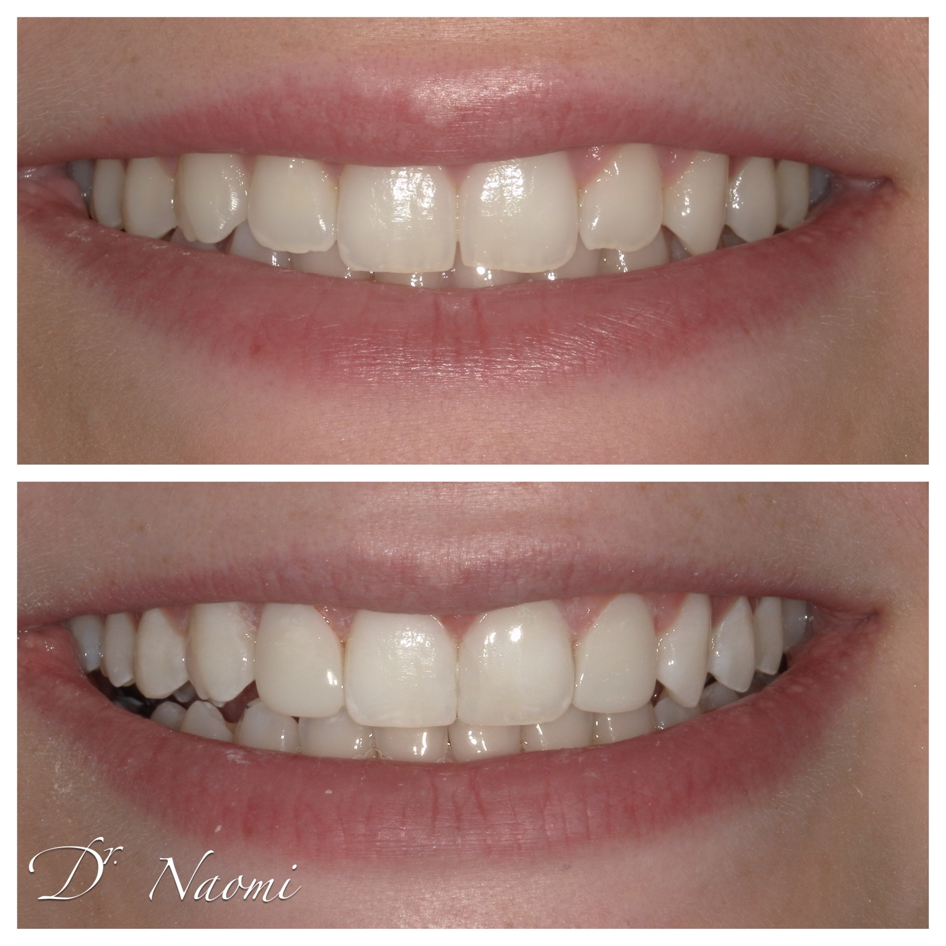 A before and after photo of a woman 's teeth by dr naomi