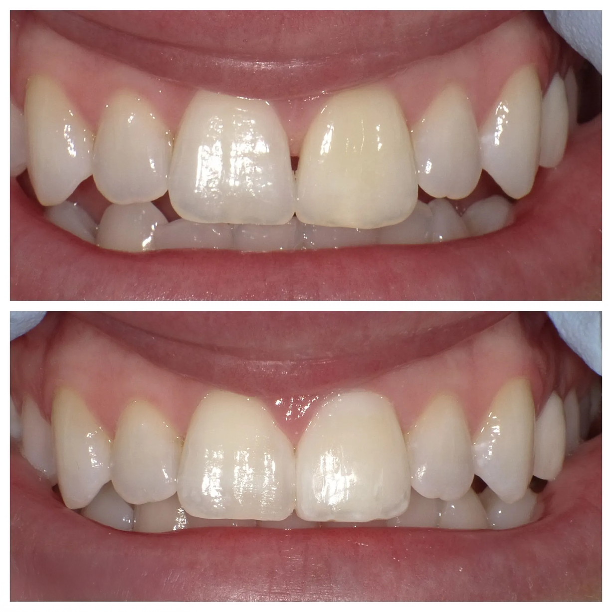 Close-up of upper front teeth before and after whitening, shown in two stacked images.