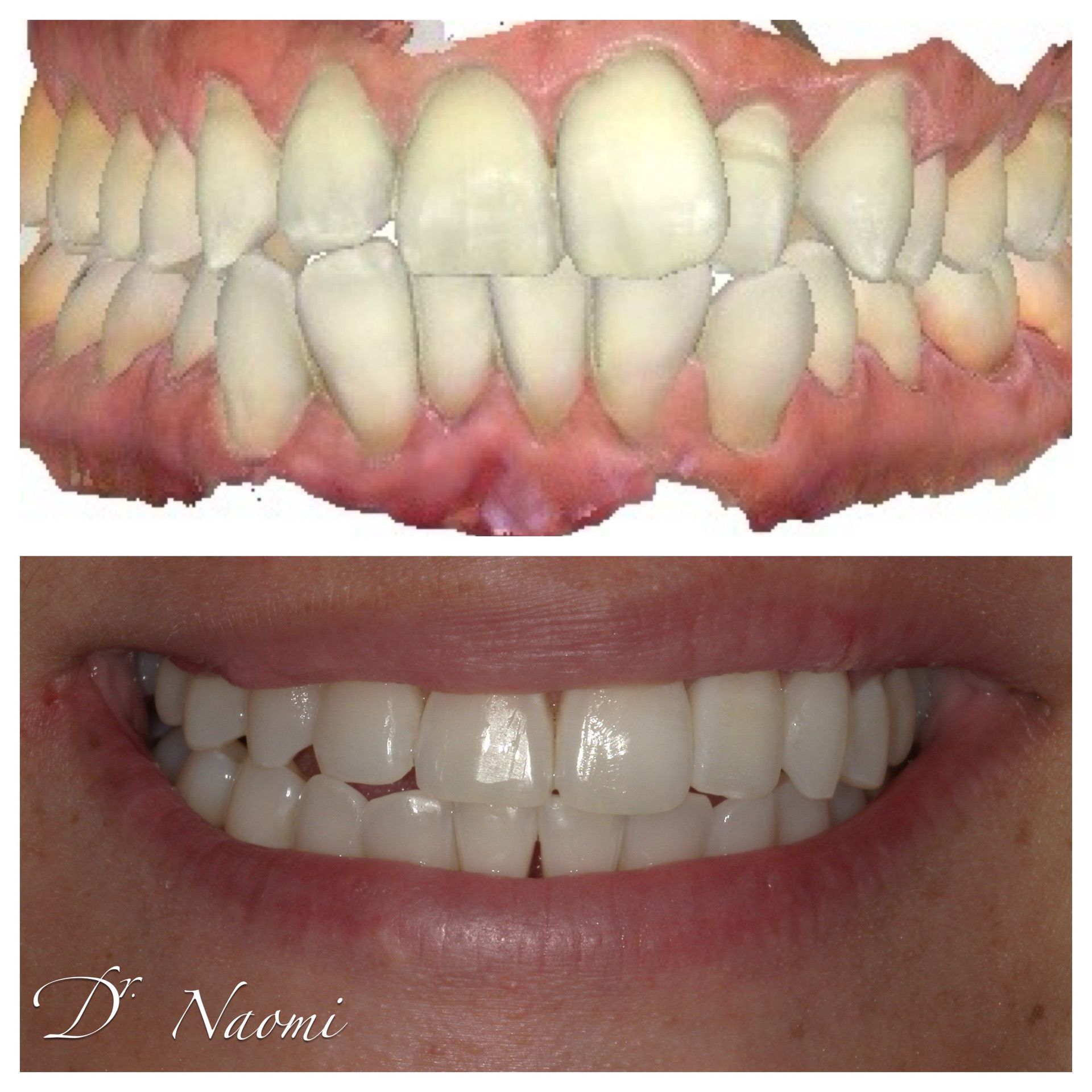 Before-and-after dental close-up showing corrected teeth alignment and a brighter smile
