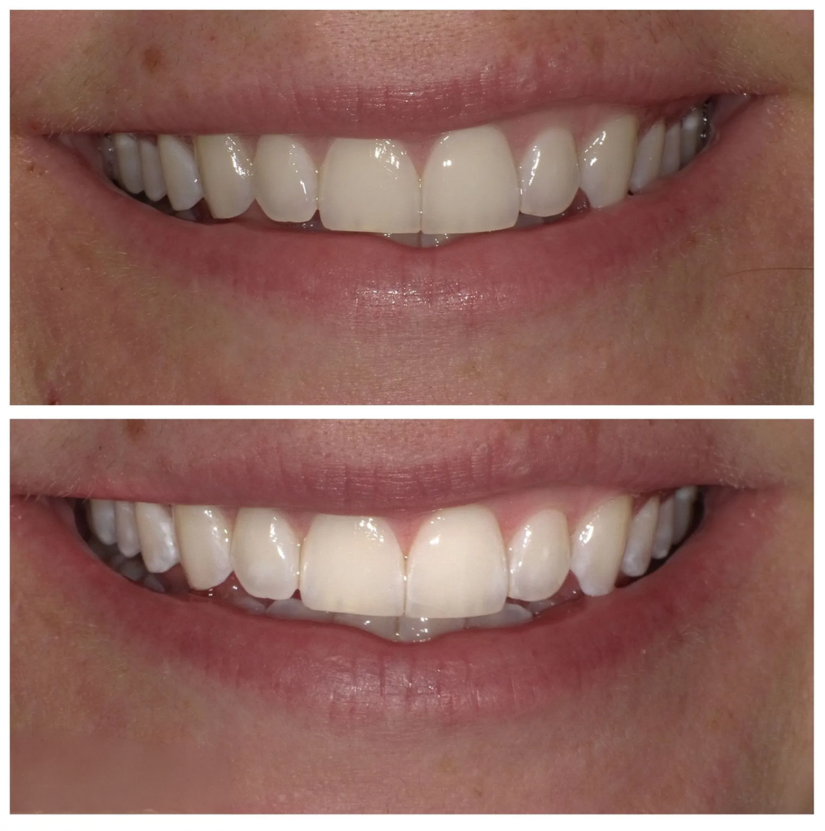 Close-up of a smiling mouth showing teeth, with one centered upper front tooth slightly protruding.