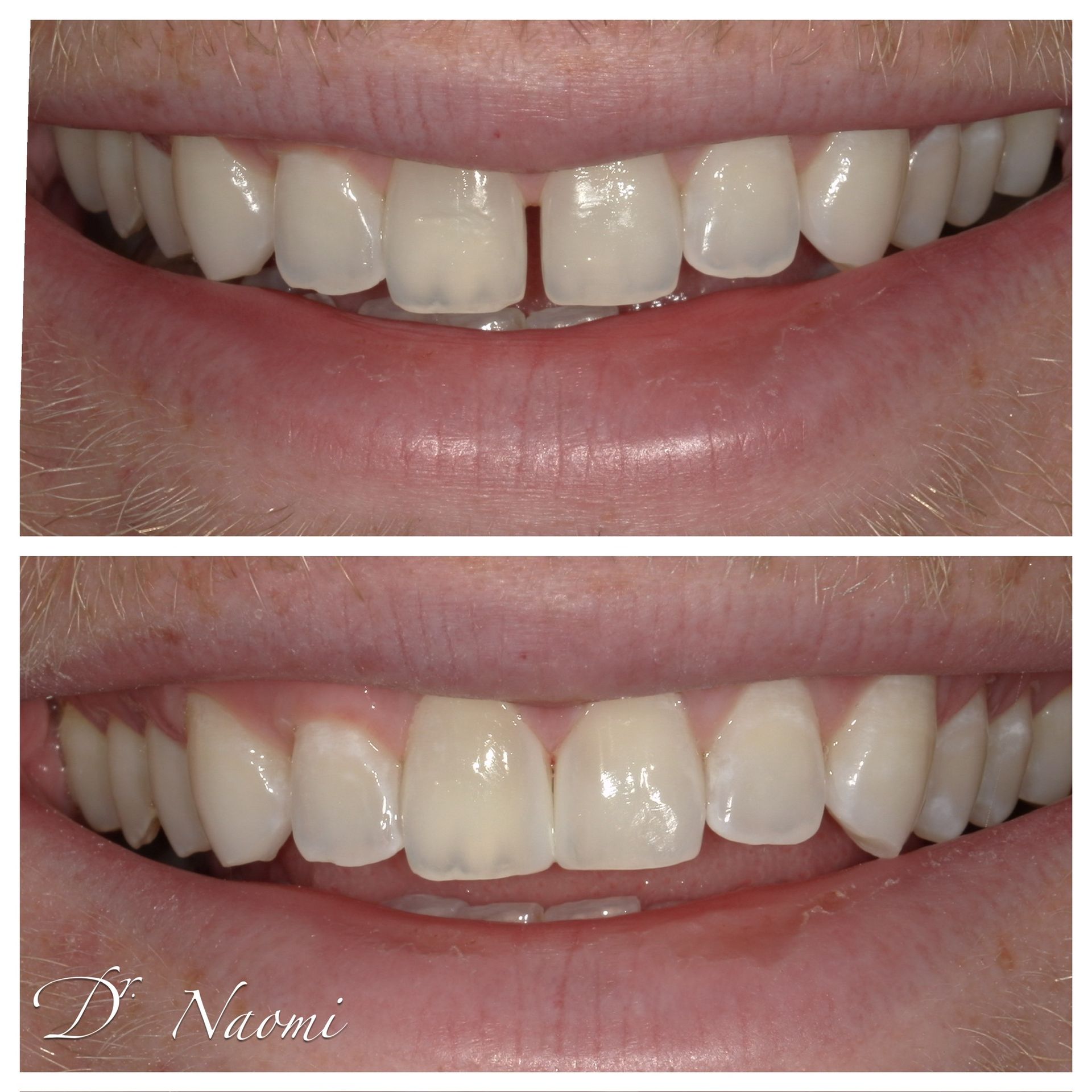Before-and-after close-up of teeth whitening, showing a smile with front teeth gaps and improved whiteness.