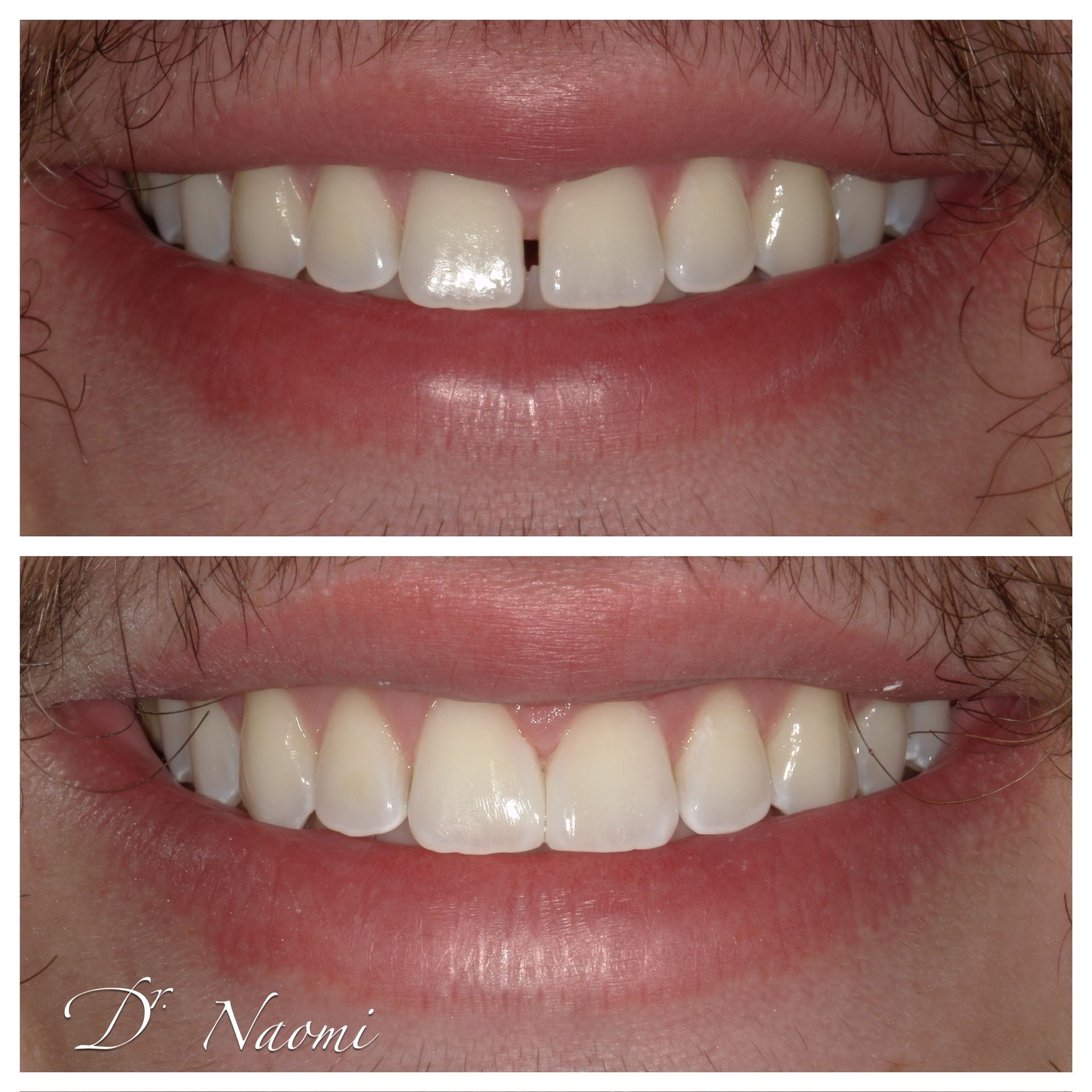 Close-up of teeth before and after whitening, with brighter white teeth in the lower photo.