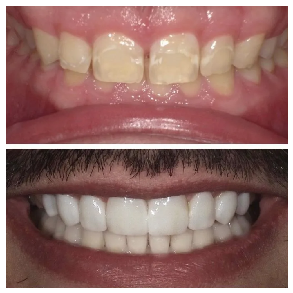 Before-and-after close-up of teeth, showing yellowed teeth above and whiter teeth below.