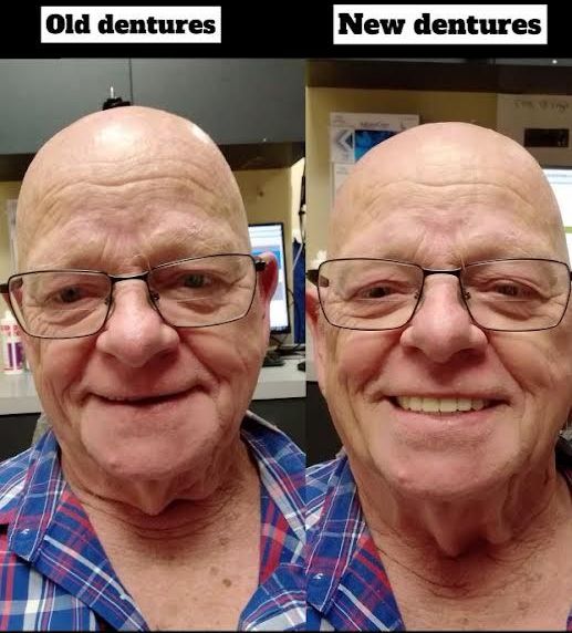 Dental Zone-Cleburne-Texas-Dentures-Old vs New