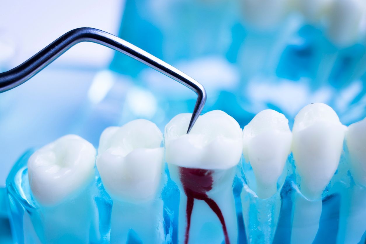 Root Canals