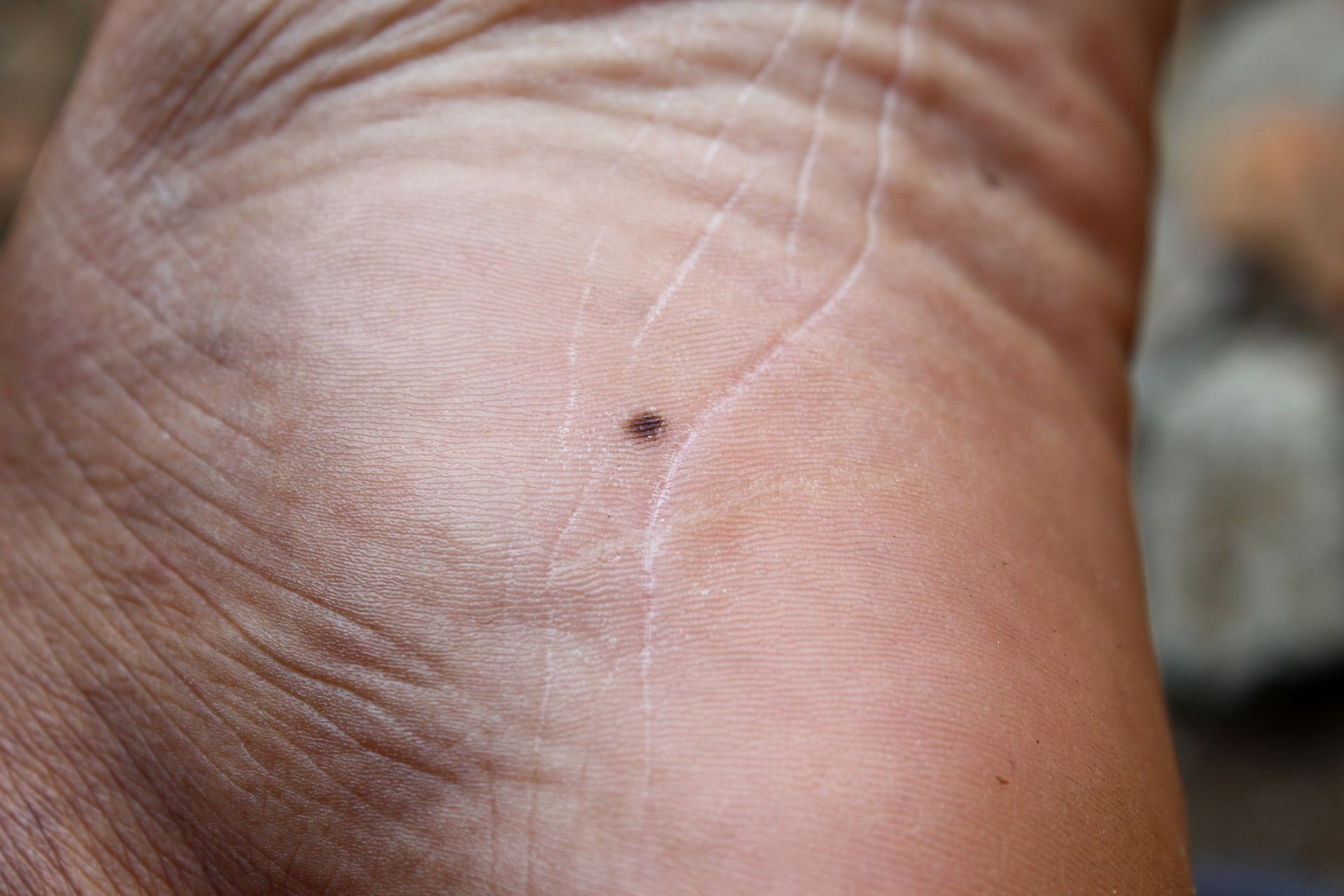 Close-up of a foot sole, showing a small, dark mole and skin texture.