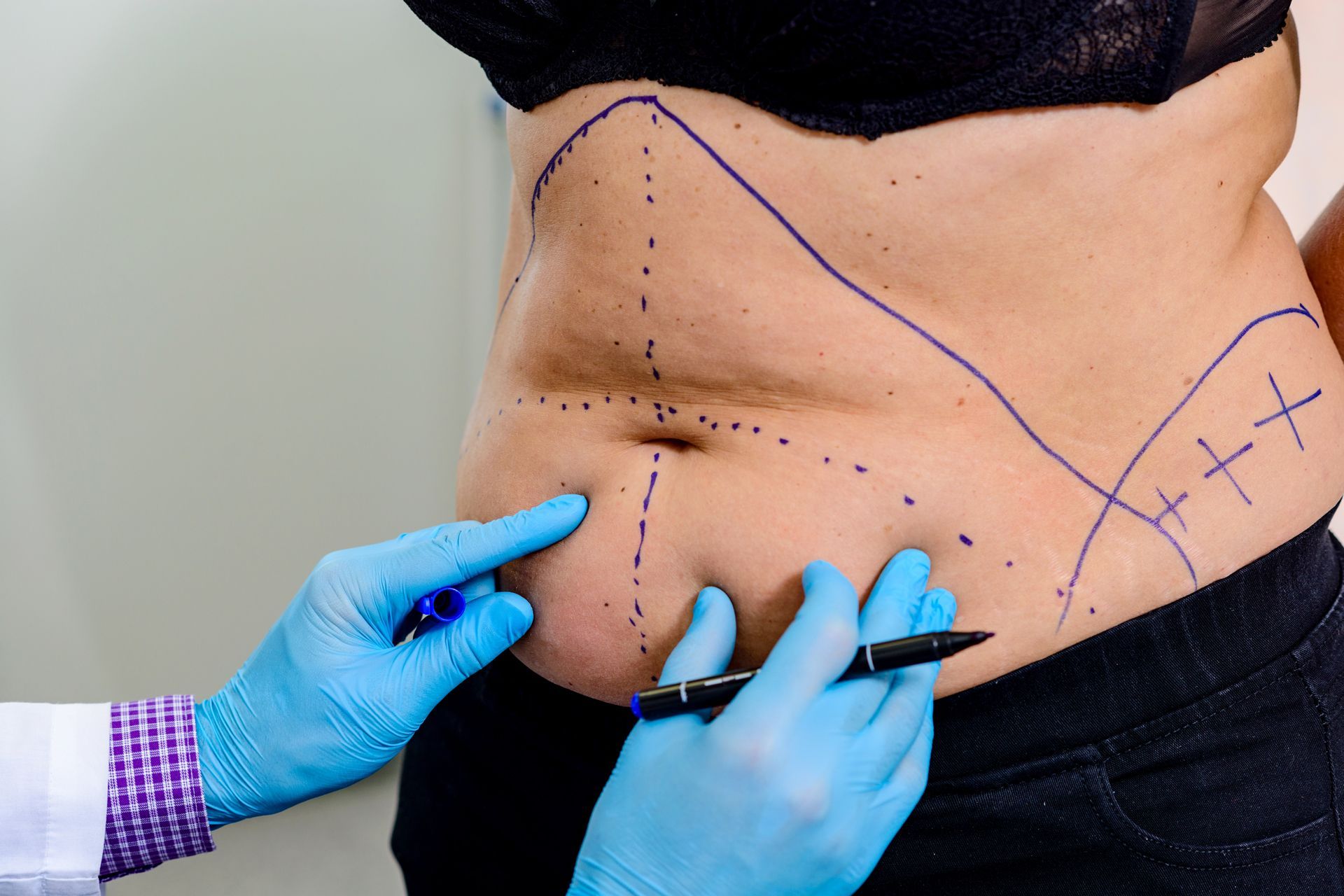 Gloved hands mark a patient’s abdomen with surgical lines and measurements before a procedure
