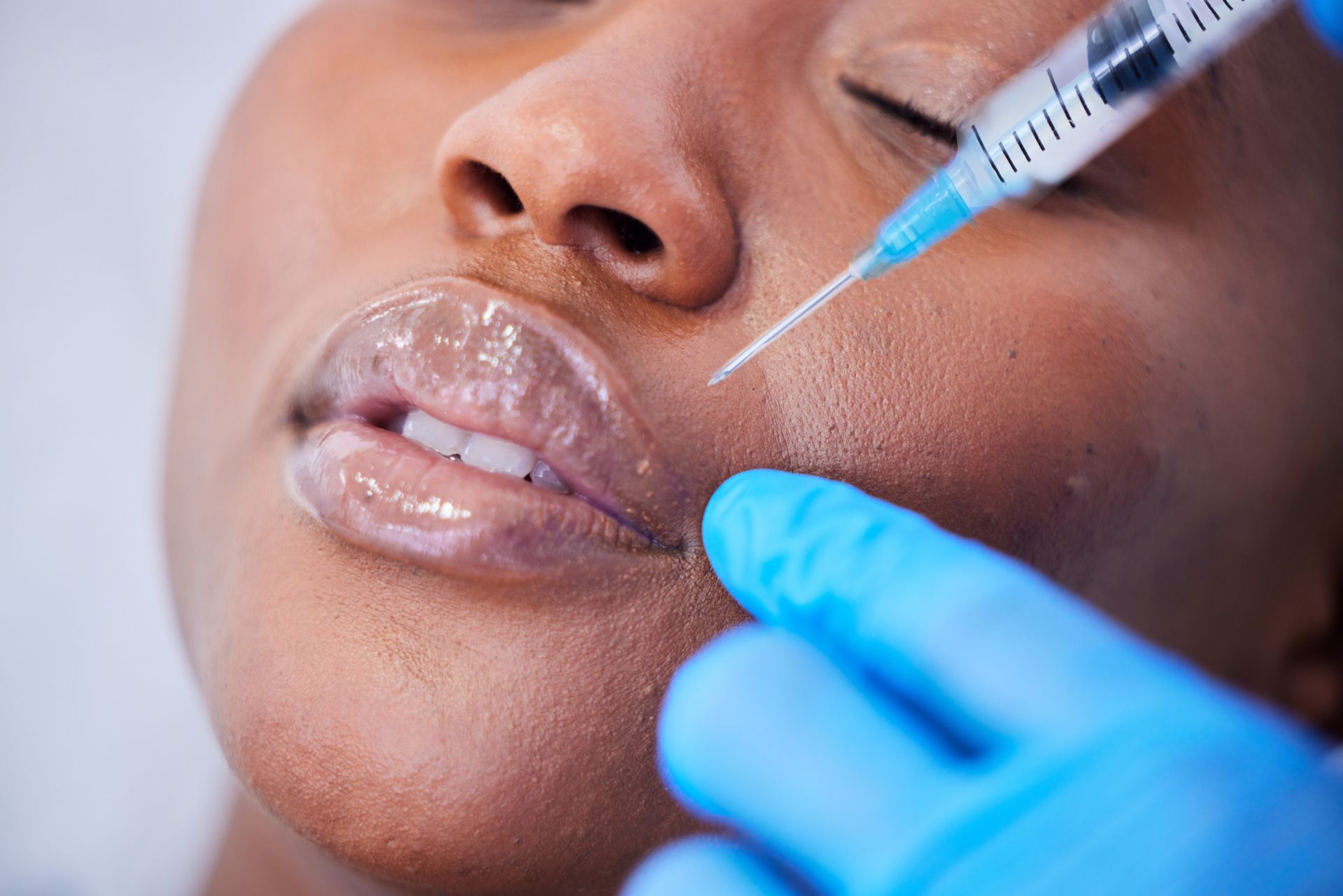 Close-up of a person receiving lip filler injection from a gloved clinician
