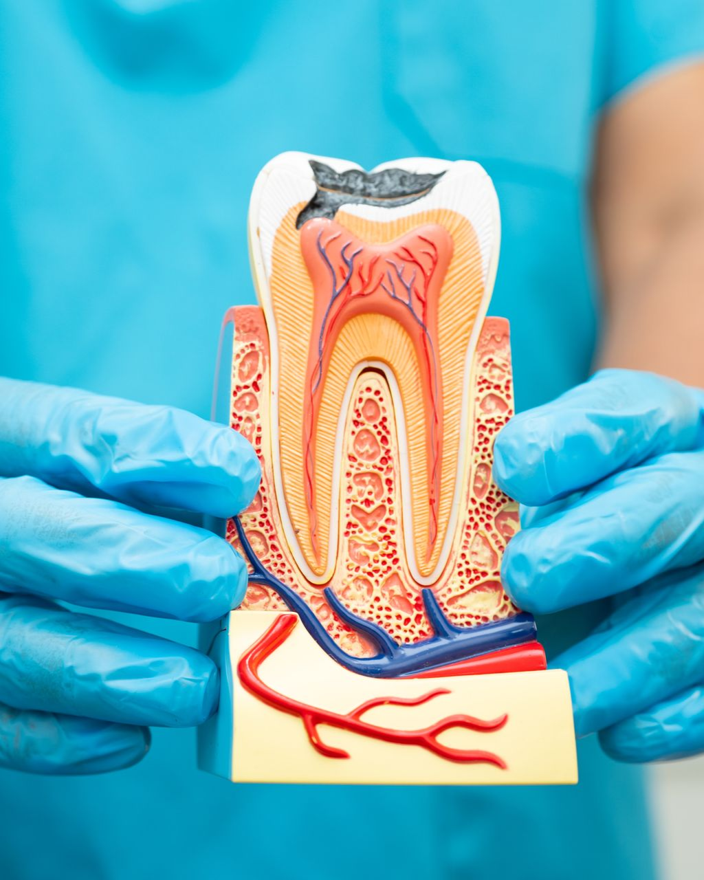 Gloved hands holding a dental cross-section model showing tooth roots and nerves