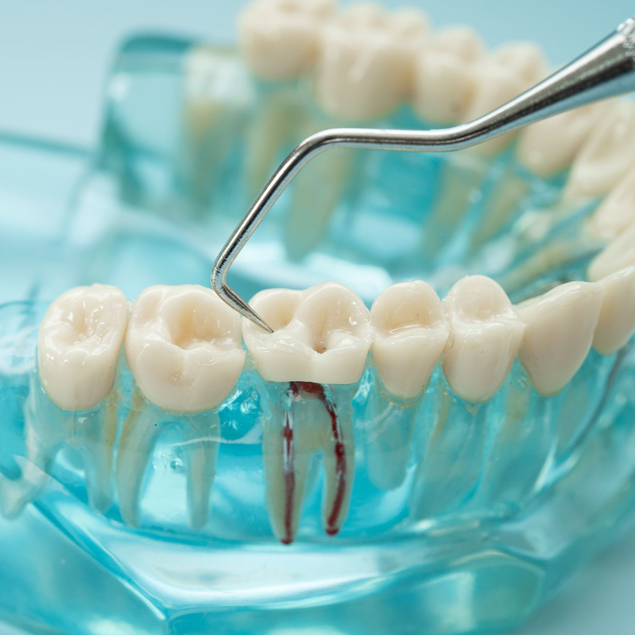 Dental model with a metal tool examining teeth and a red-capped implant in a blue gum mold