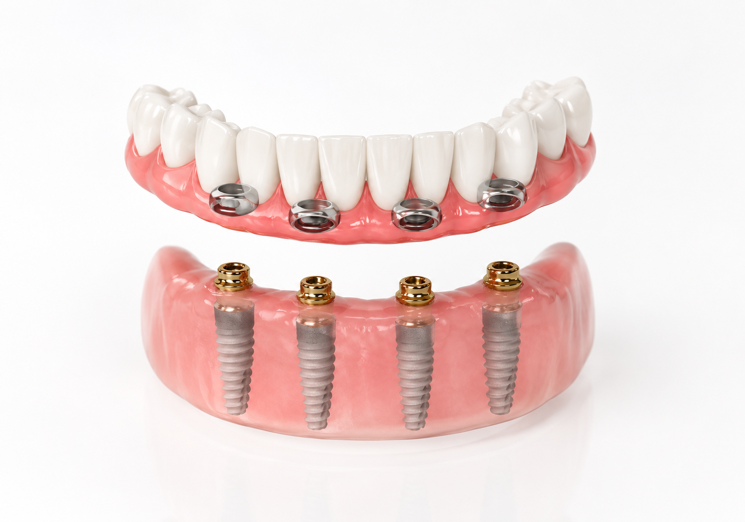 Upper and lower dental implant overdentures