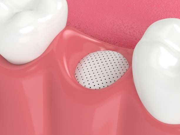 Dental implant post between two teeth in a pink gum area