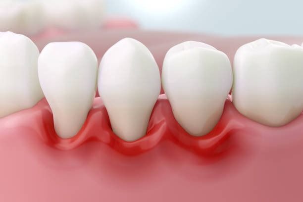 Close-up of receding gums around several white teeth