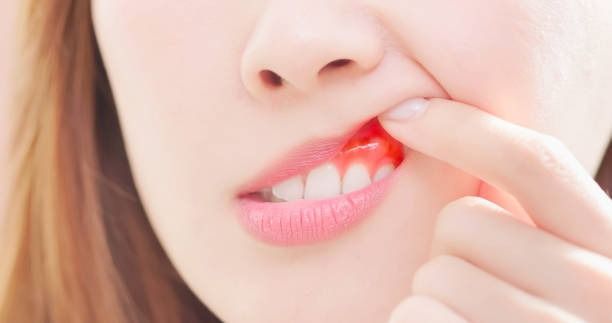 Close-up of a person pulling down their lower lip to show a red sore