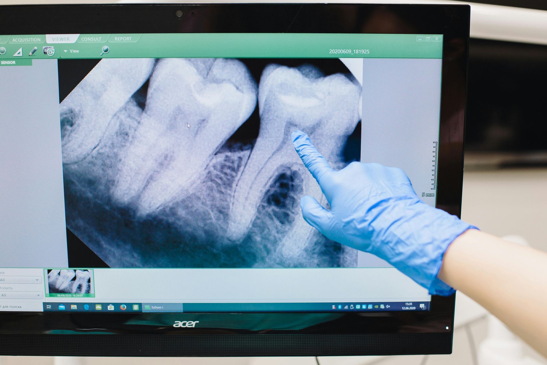 Dentist pointing at a tooth x-ray displayed on a monitor