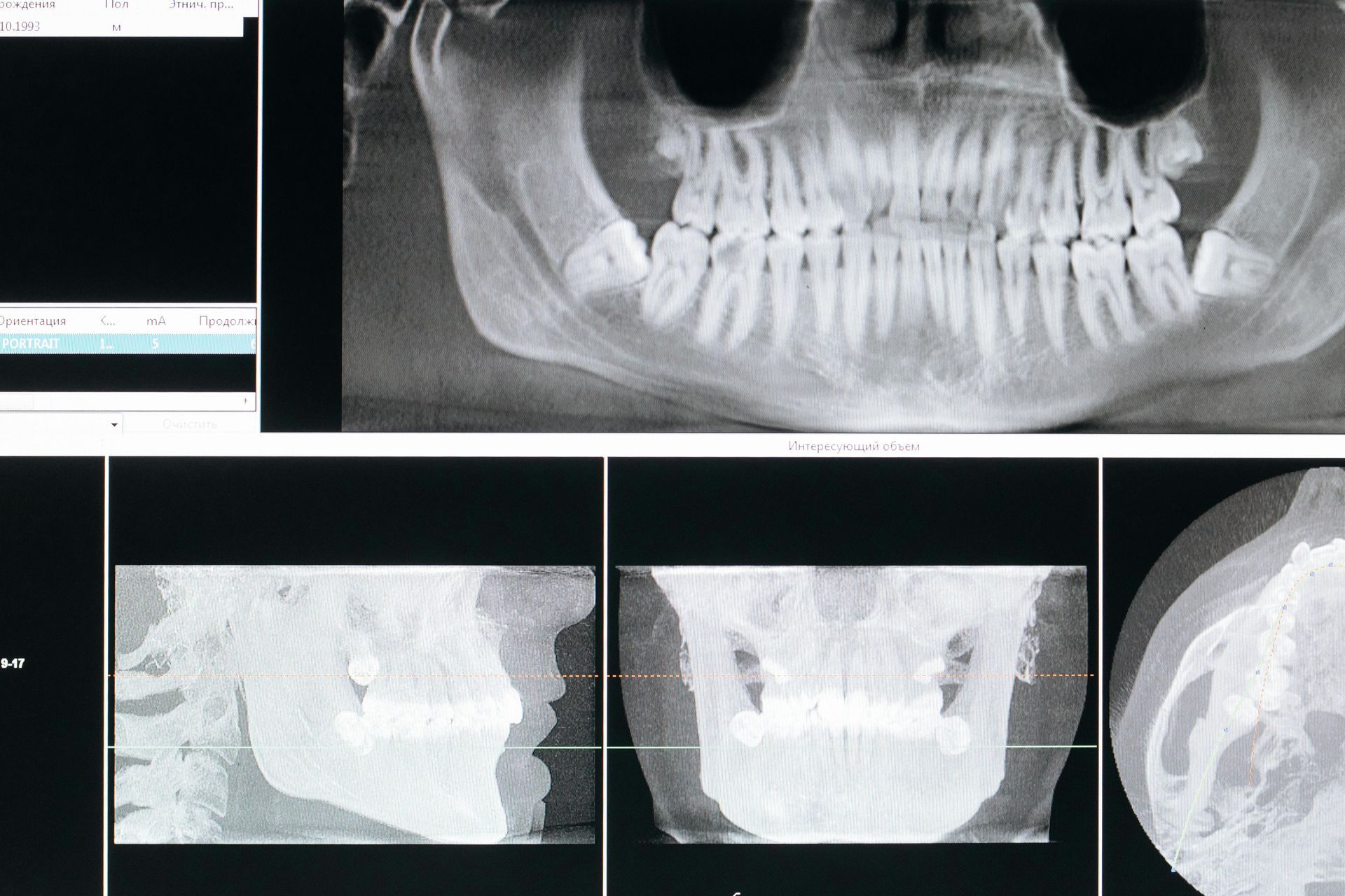 Dental X-ray viewer showing panoramic and side-view jaw scans