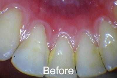 Before teeth cleaning at Aurora Dental Care