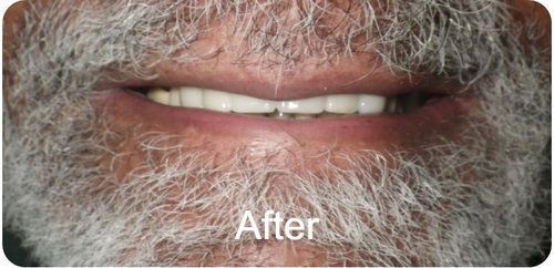 After a Dental Implant Bridge
