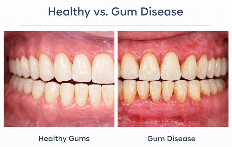 Healthy vs. gum disease: side-by-side close-up of gums and teeth, showing pink healthy gums and red inflamed gums.