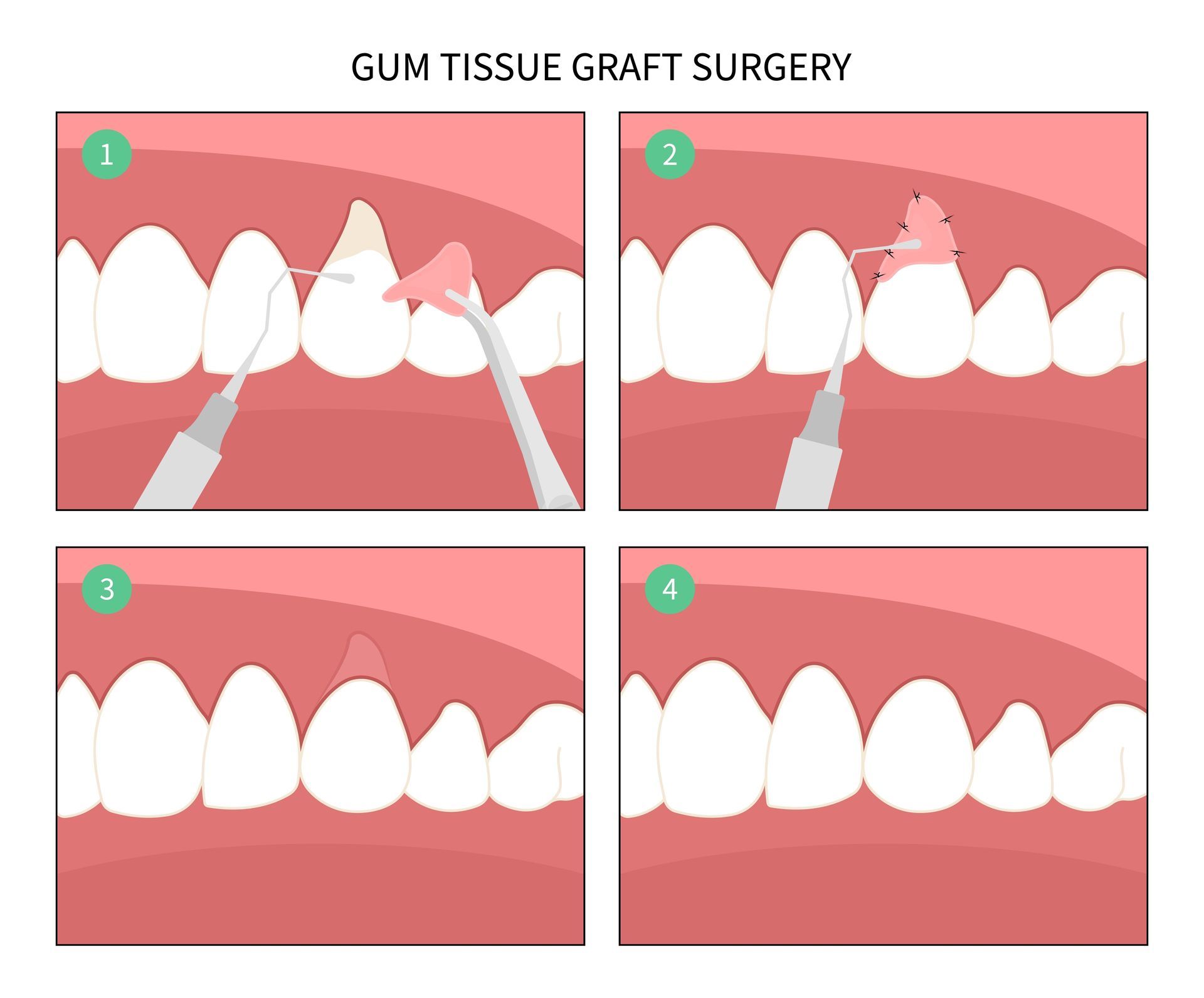 Four-panel diagram showing gum tissue graft surgery steps with teeth and pink gums