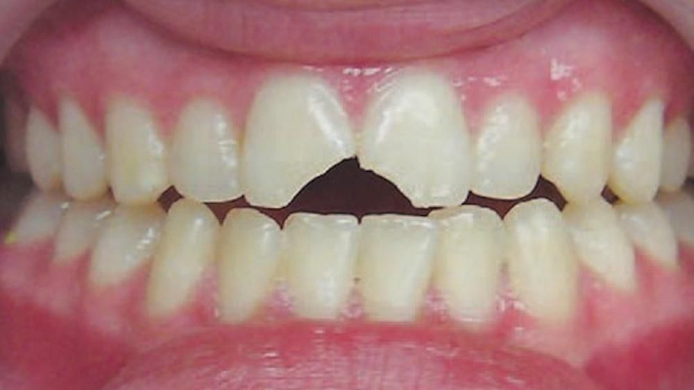 Chipped teeth from one of our patients in North Seattle