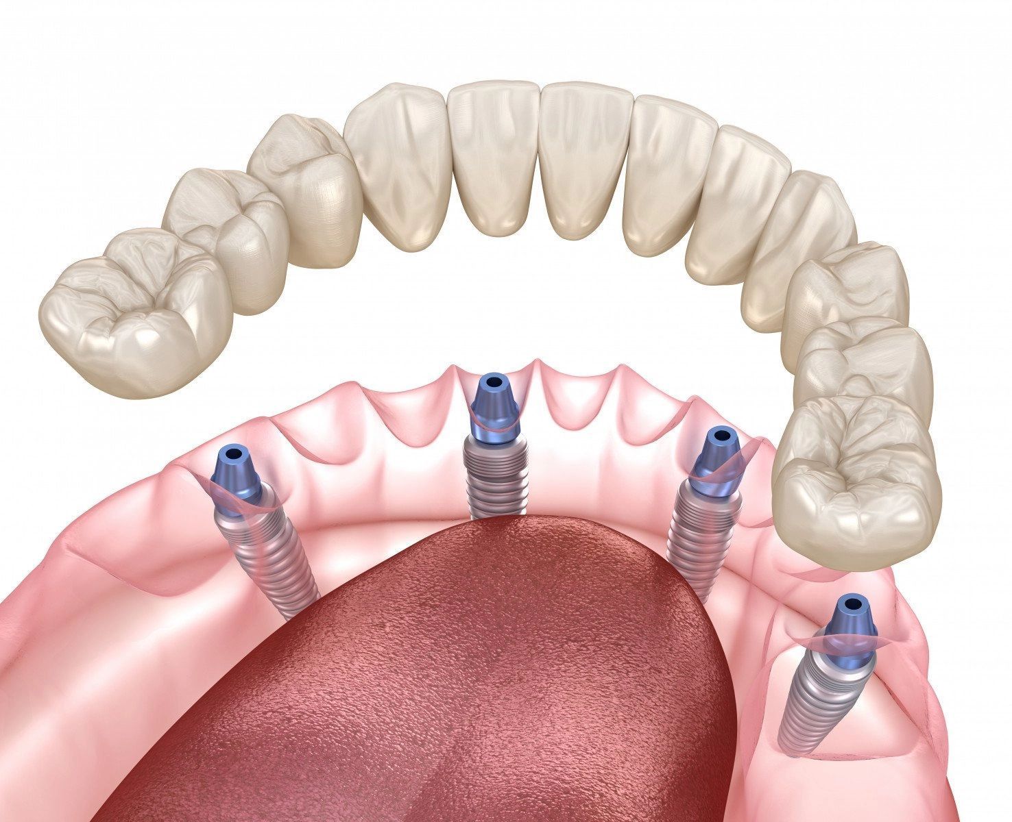 Seattle Area Dental Implants