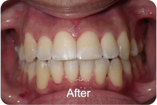 Before Braces 3