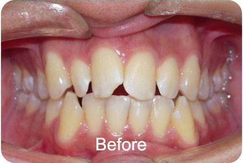 Before Braces 3