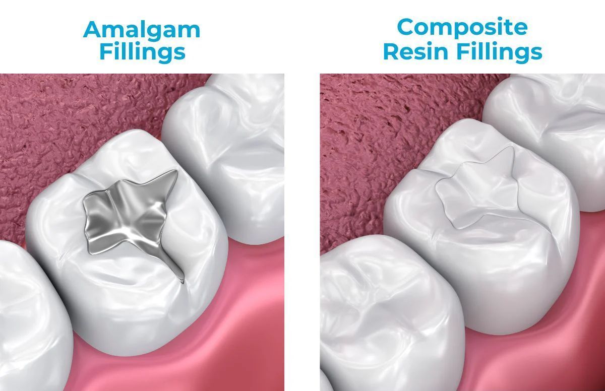 Composite fillings in Seattle WA