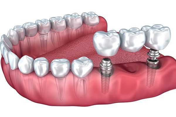 Seattle Dental Implants
