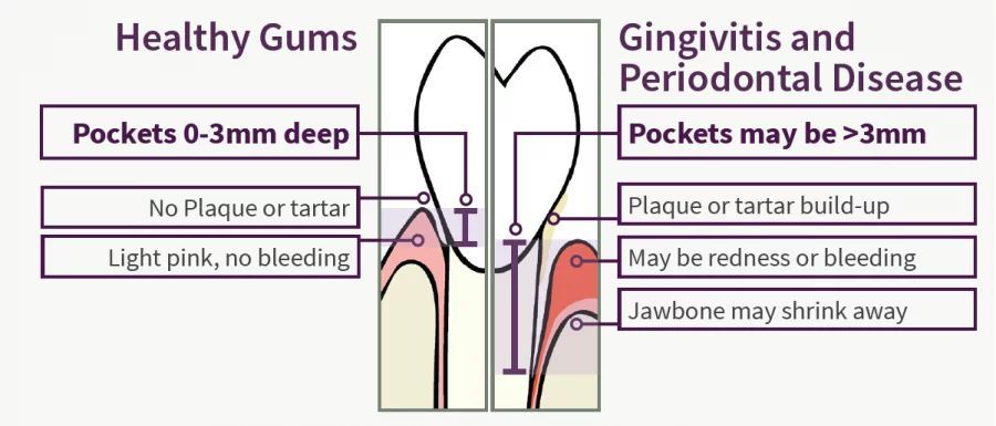 Diagram comparing healthy gums and gingivitis/periodontal disease with pocket depths and symptoms.