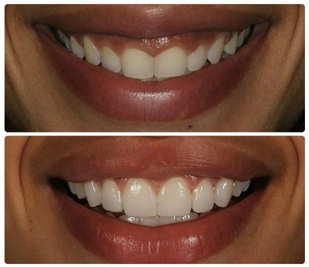 Before and after cosmetic gum shaping