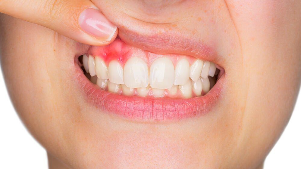 Finger pulling up upper lip to show red, swollen gum above front teeth
