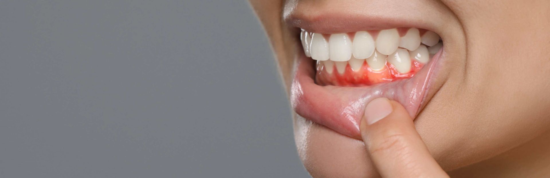 Close-up of a person pulling down their lower lip to reveal red, irritated gums and teeth.